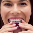 Pacjentka Invisalign zakłada nakładki na zęby