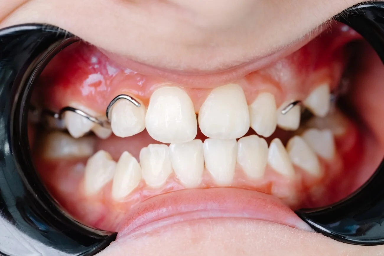 Dlaczego regularne wizyty u ortodonty są kluczowe dla zdrowia jamy ustnej?